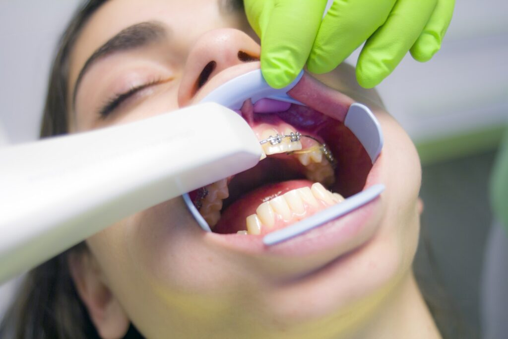 Advantages and Disadvantages of Laser Teeth Whitening