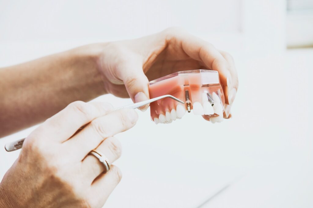 Teeth Whitening Before or After Dental Implants