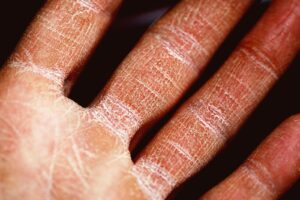 Telling The Difference Between Psoriasis And Eczema