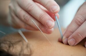 Consider Acupuncture For Backaches