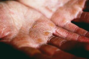 Eczema - The Skin Disorder That's More Common Than You Thought