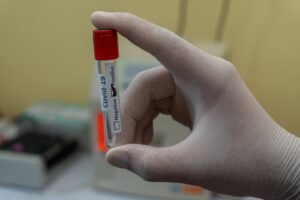 Blood Tests for the Diagnosis of Cirrhosis