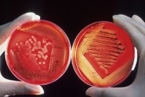 MRSA Symptoms - Causes and Risk Factors - Complications and Treatments