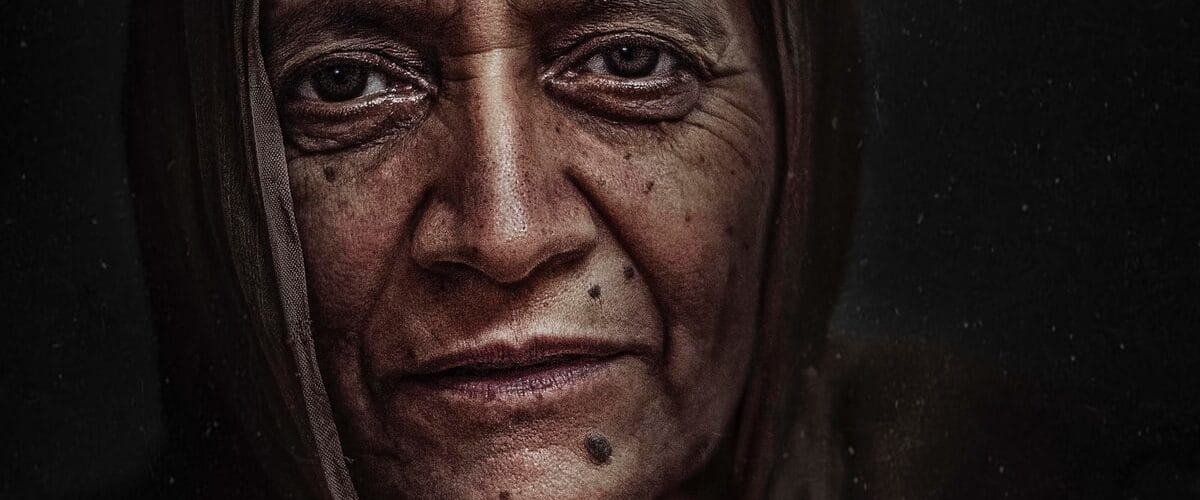 Causes and Modern Day Treatments for Acne Scarring