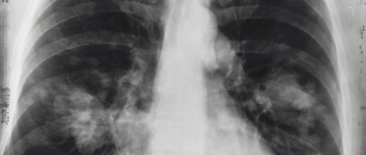 Methods For Natural Relief From Asthma