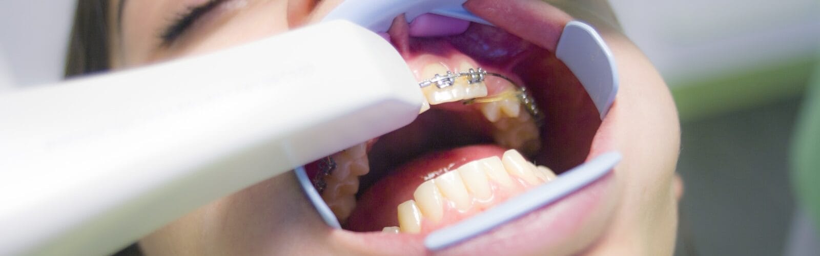 What To Know About Laser Teeth Whitening