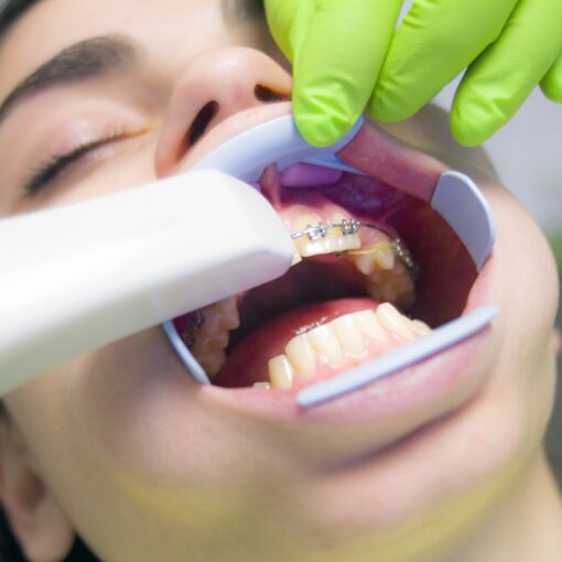 What To Know About Laser Teeth Whitening