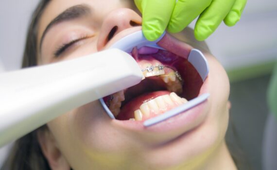 What To Know About Laser Teeth Whitening