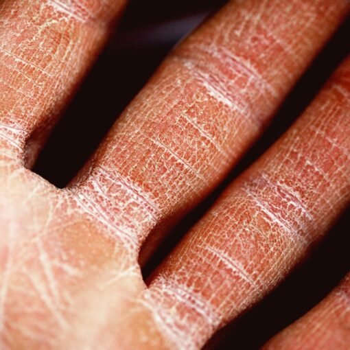 Telling The Difference Between Psoriasis And Eczema