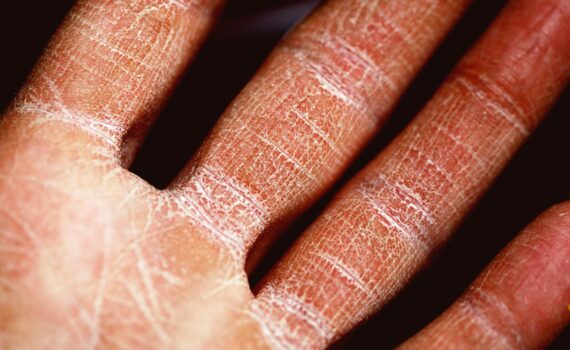 Telling The Difference Between Psoriasis And Eczema