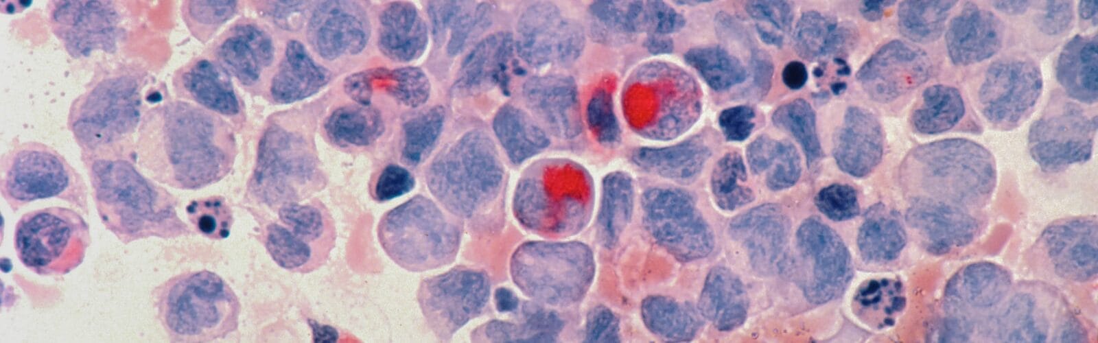 Tips For Fighting Cancer And Also Living With Cancer