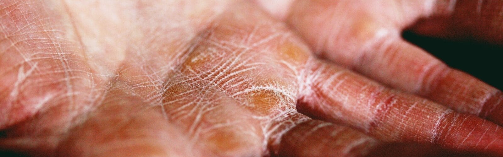 Eczema - The Skin Disorder That's More Common Than You Thought
