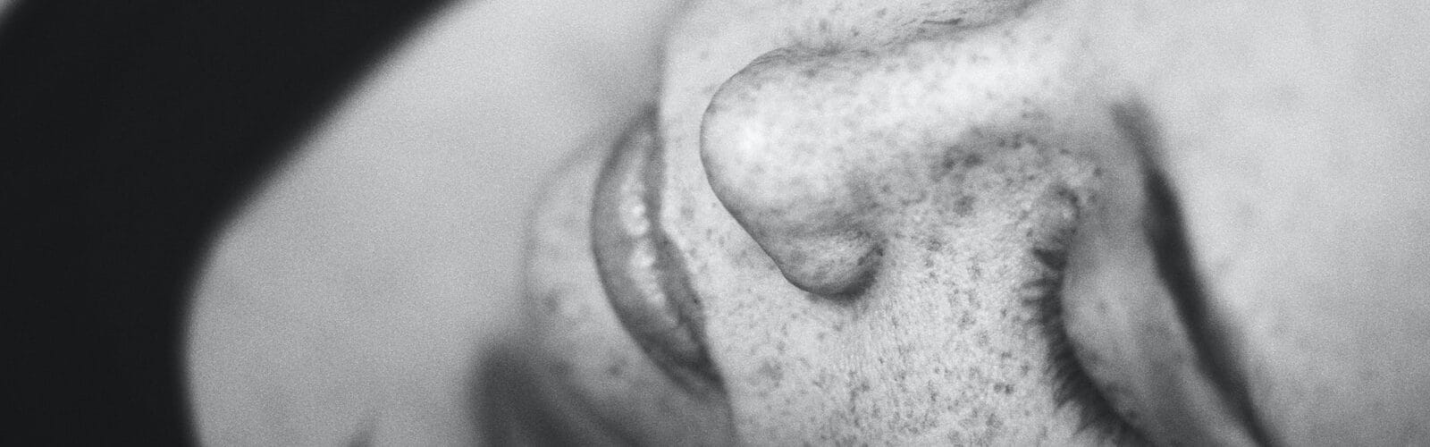 Dealing With Sleep Apnea - Tips For Prevention freckles