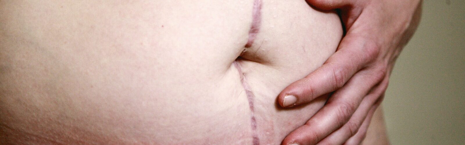 Diverticulitis Symptoms of Causes and Risk Factors - Complications and Treatments