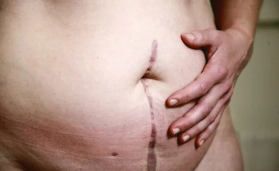 Diverticulitis Symptoms of Causes and Risk Factors - Complications and Treatments