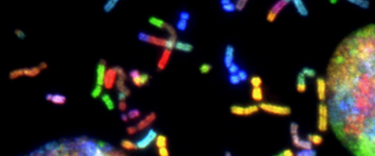 Cystic Fibrosis Symptoms of Causes and Risk Factors - Complications and Treatments