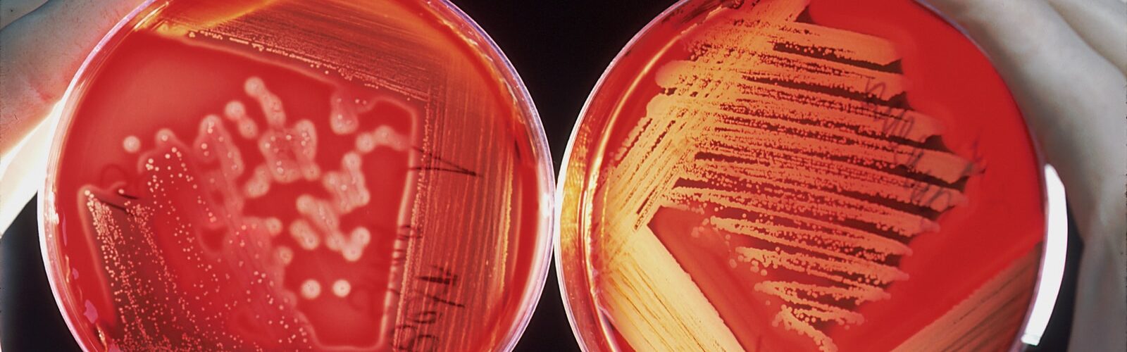 MRSA Symptoms - Causes and Risk Factors - Complications and Treatments
