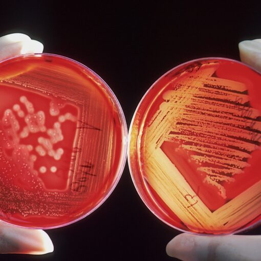 MRSA Symptoms - Causes and Risk Factors - Complications and Treatments