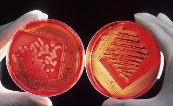 MRSA Symptoms - Causes and Risk Factors - Complications and Treatments