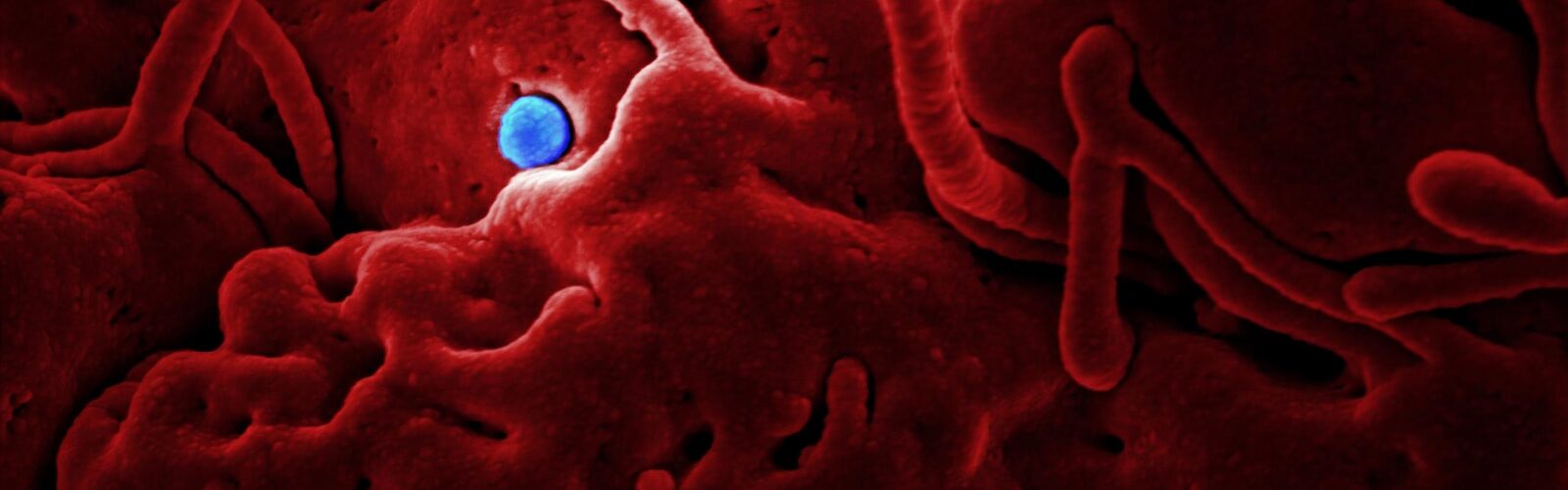 Methicillin-Resistant Staphylococcus Aureus Symptoms - Causes and Risk Factors - Complications and Treatments