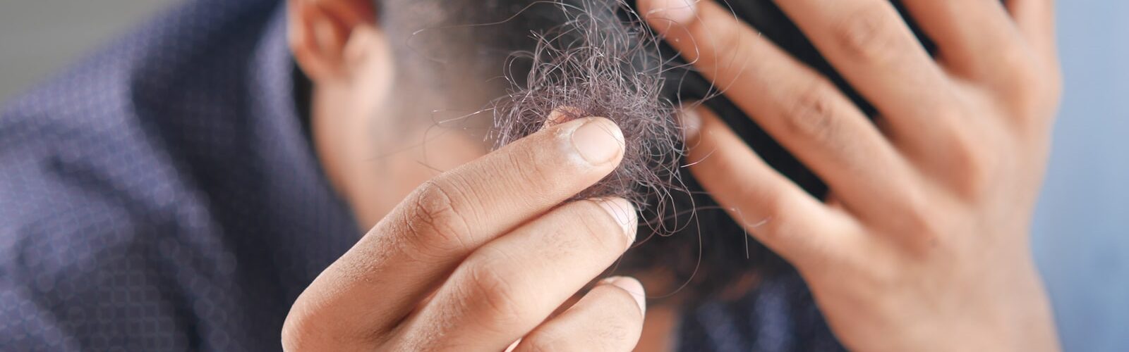 Hair Loss Treatment and Prevention