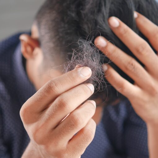 Hair Loss Treatment and Prevention